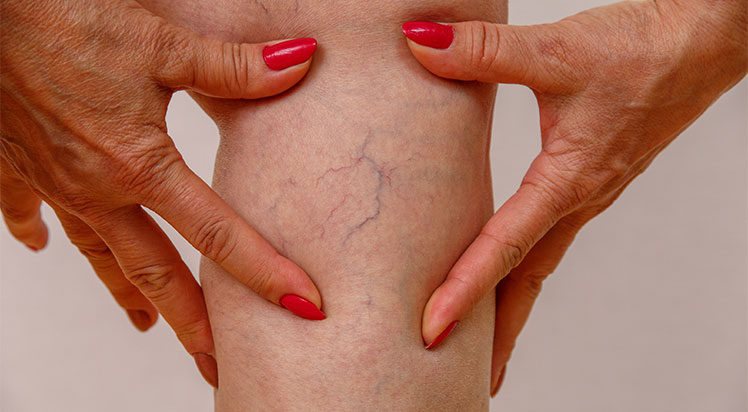 News, What are varicose veins