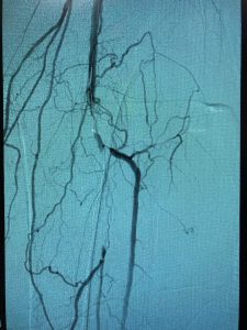 Artery Blockage before treatment