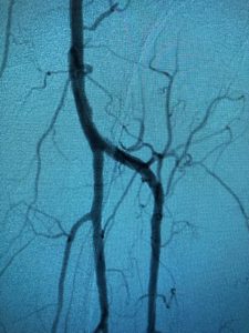 Artery Blockage - after treatment