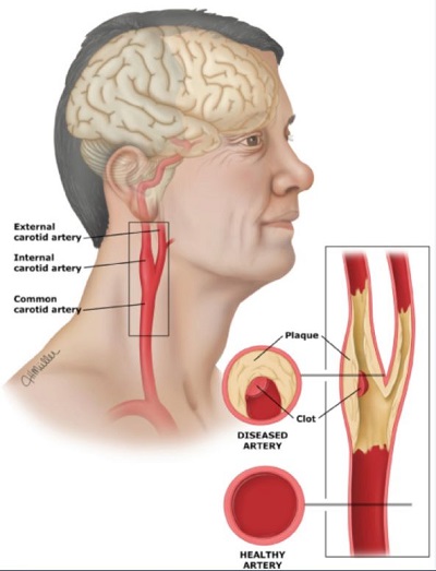 carotid arteries disease