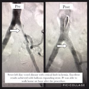Iliac Disease Case