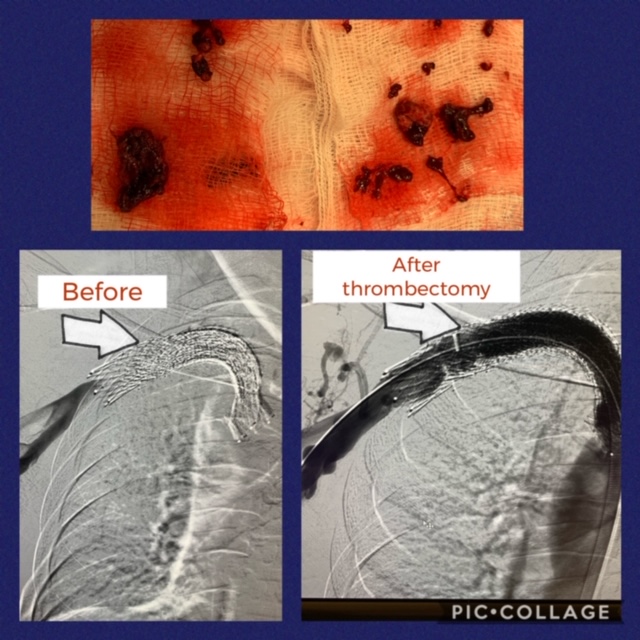 Occlusive Venous Disease