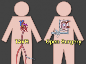 TAVR Diagram