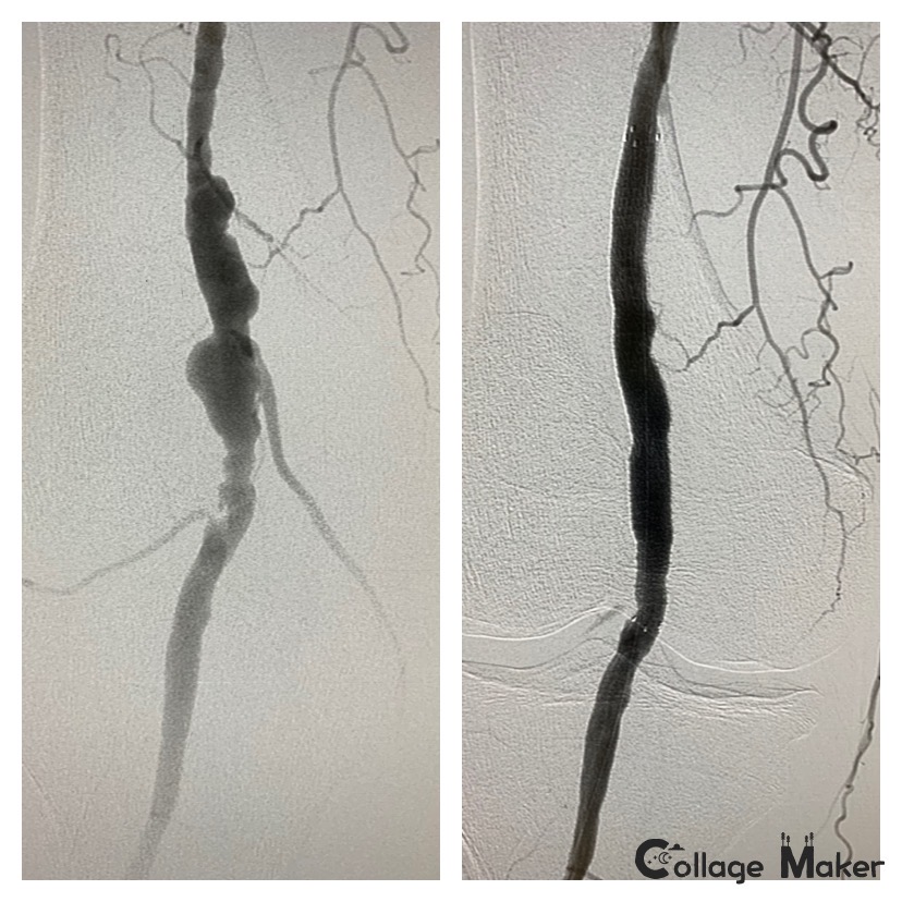 Arterial Aneurysms
