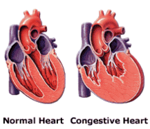 Congestive Heart Failure