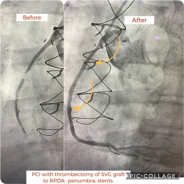 Coronary bypass grafts