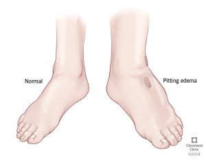 Edema Diagram