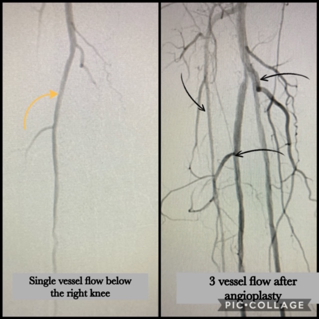pad treatment