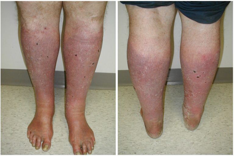Insufficiency Dermatitis