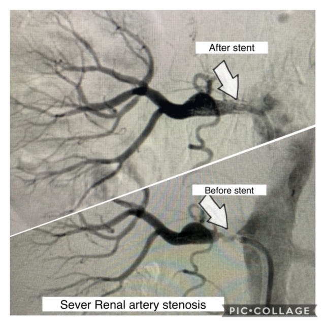 renal artery stenosis