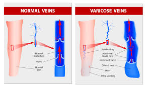 varicose diagram